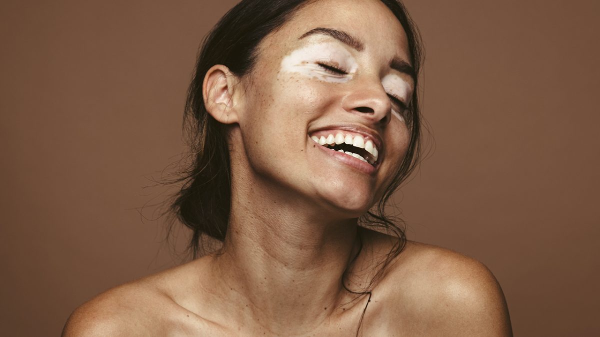 Mulher com vitiligo sorrindo