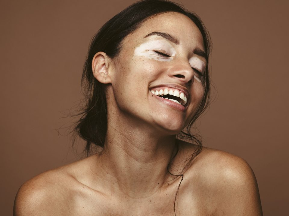 Mulher com vitiligo sorrindo